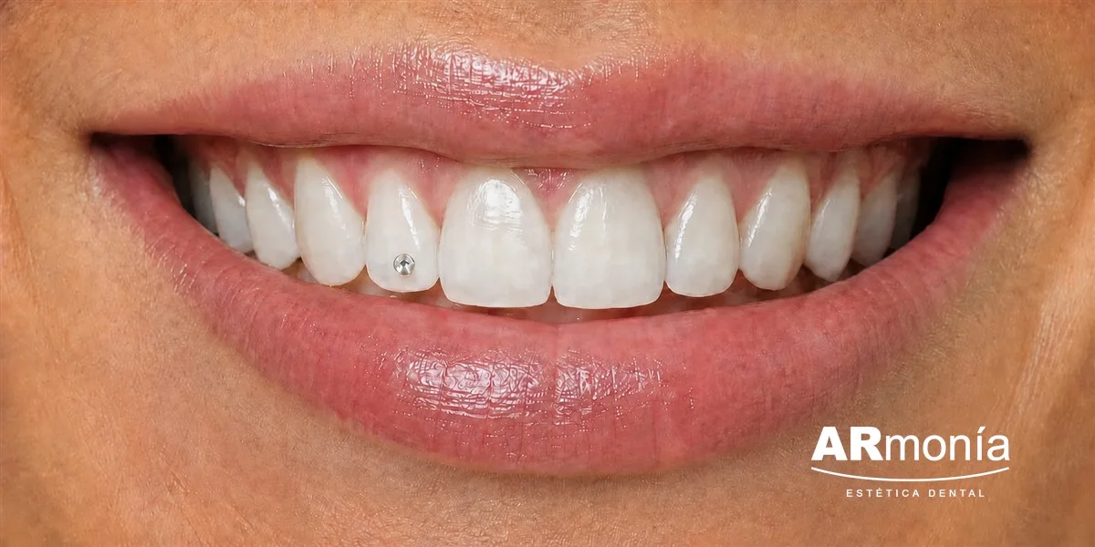 Primer plano de un brillante dental adherido sobre un incisivo