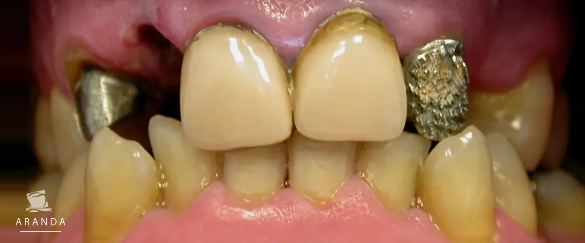 Estado dental antes del tratamiento del cuarto caso