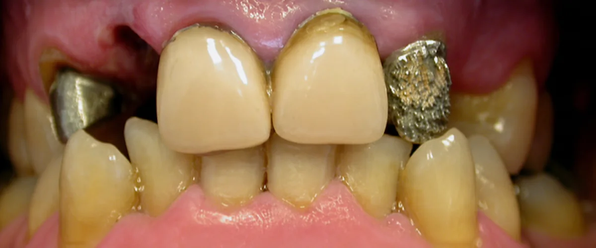 Estado dental antes del tratamiento del segundo caso