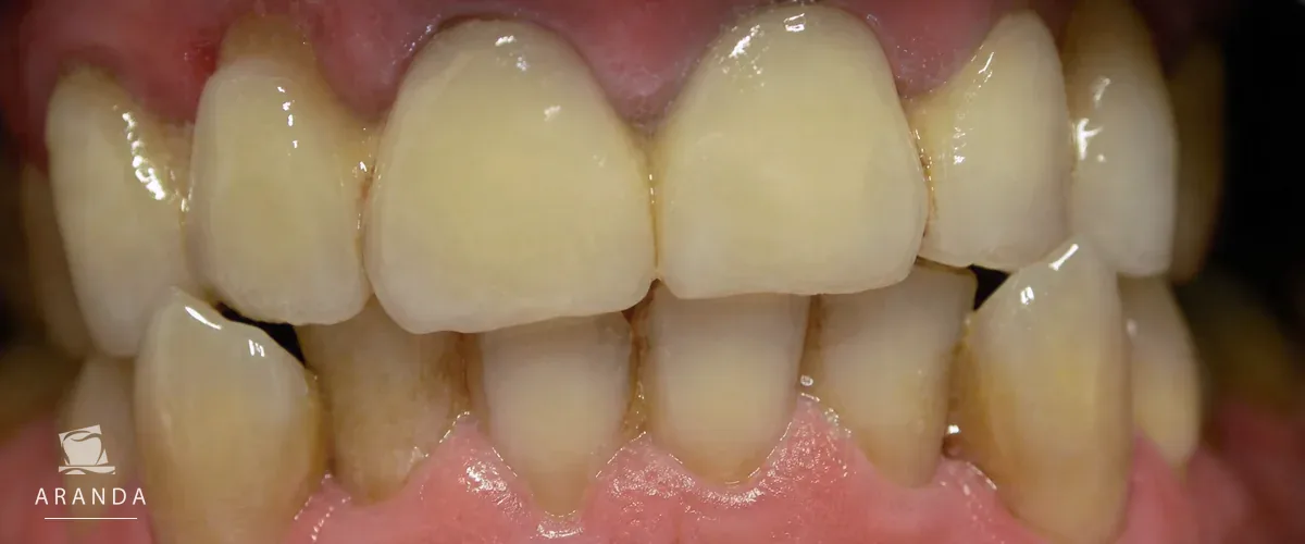 Resultado dental después del tratamiento del cuarto caso
