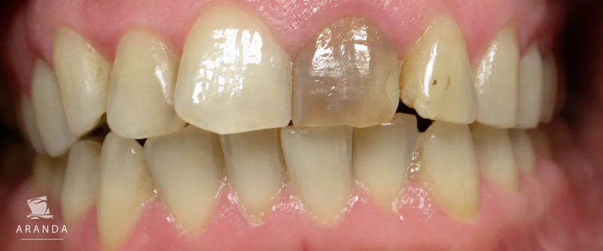 Diente anterior antes del tratamiento con corona dental