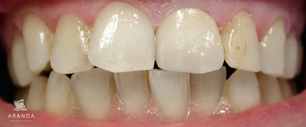Resultado después del tratamiento con corona dental