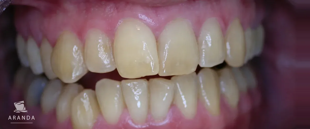 Color dental antes del tratamiento del tercer caso