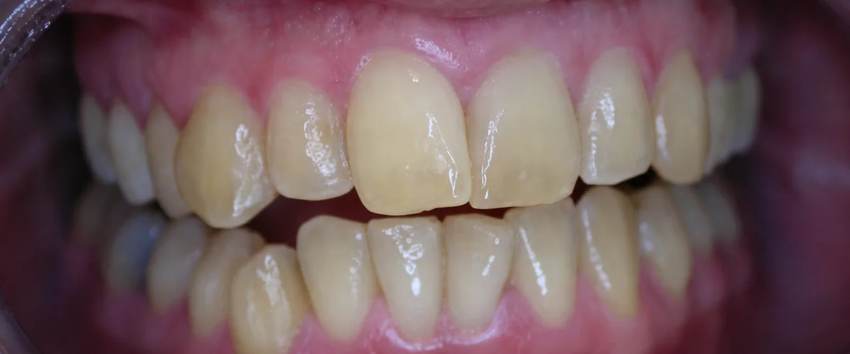 Color dental antes del tratamiento del tercer caso