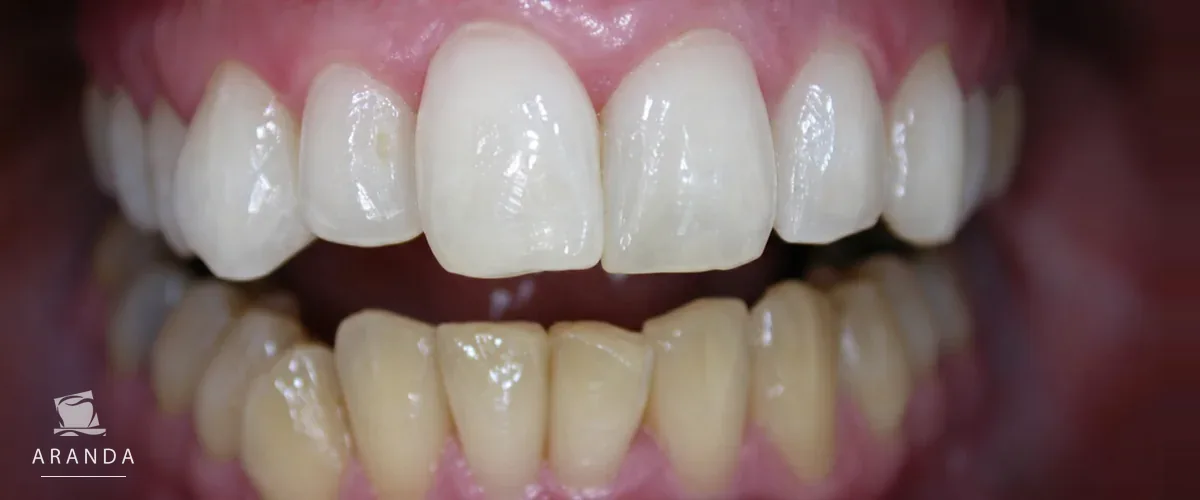Color dental después del tratamiento del tercer caso