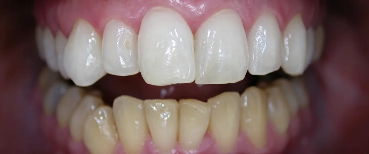 Color dental después del tratamiento del tercer caso
