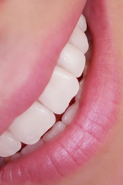 Detalle de dientes y labios en un tratamiento de estética dental en Córdoba
